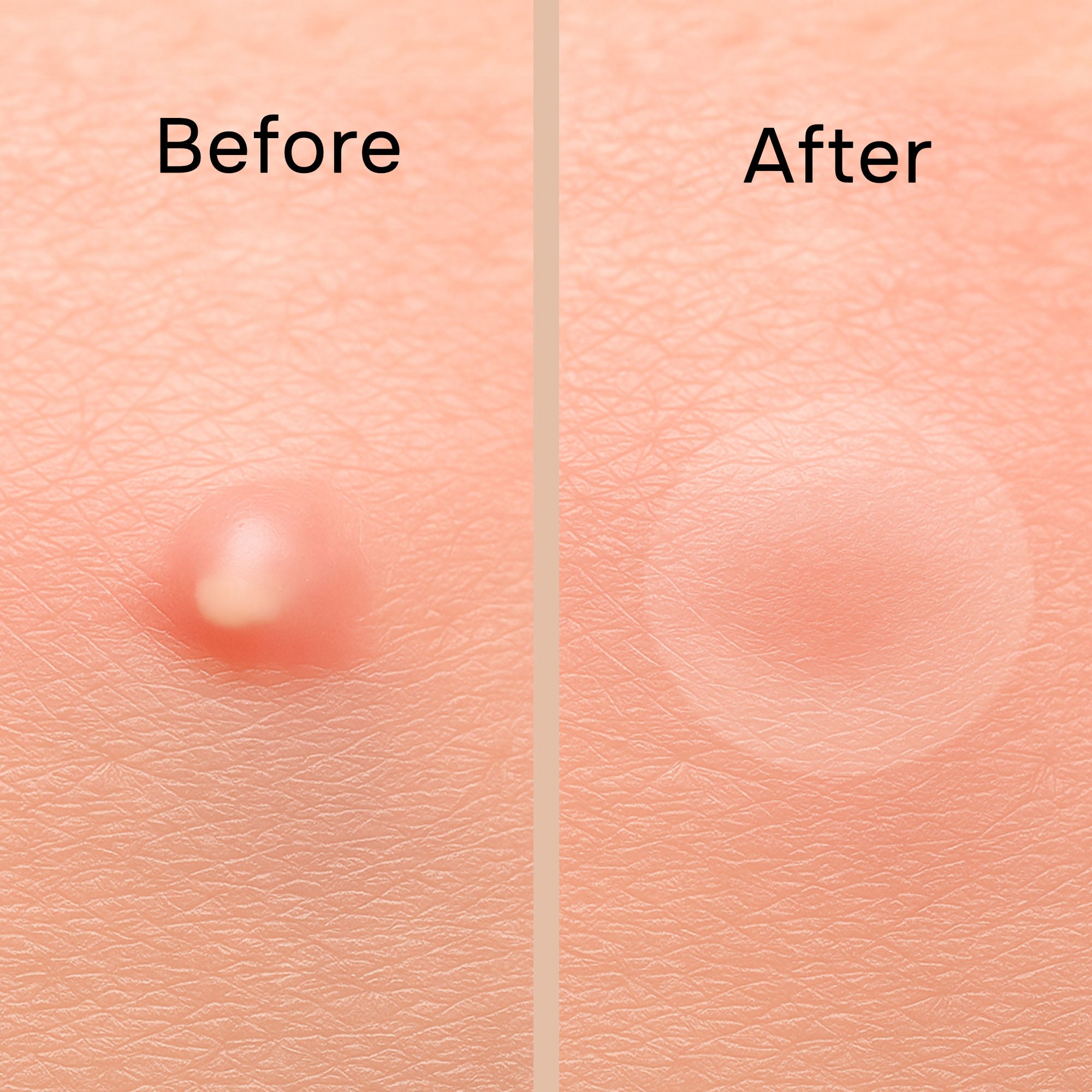 Acne Pimple Patch